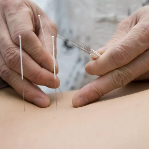 physical-therapy-clinic-services-dry-needling-national-pt-holbrook-brockton-fall-river-stoughton-hanover-mansfield-ma