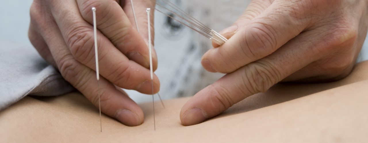 Dry Needling